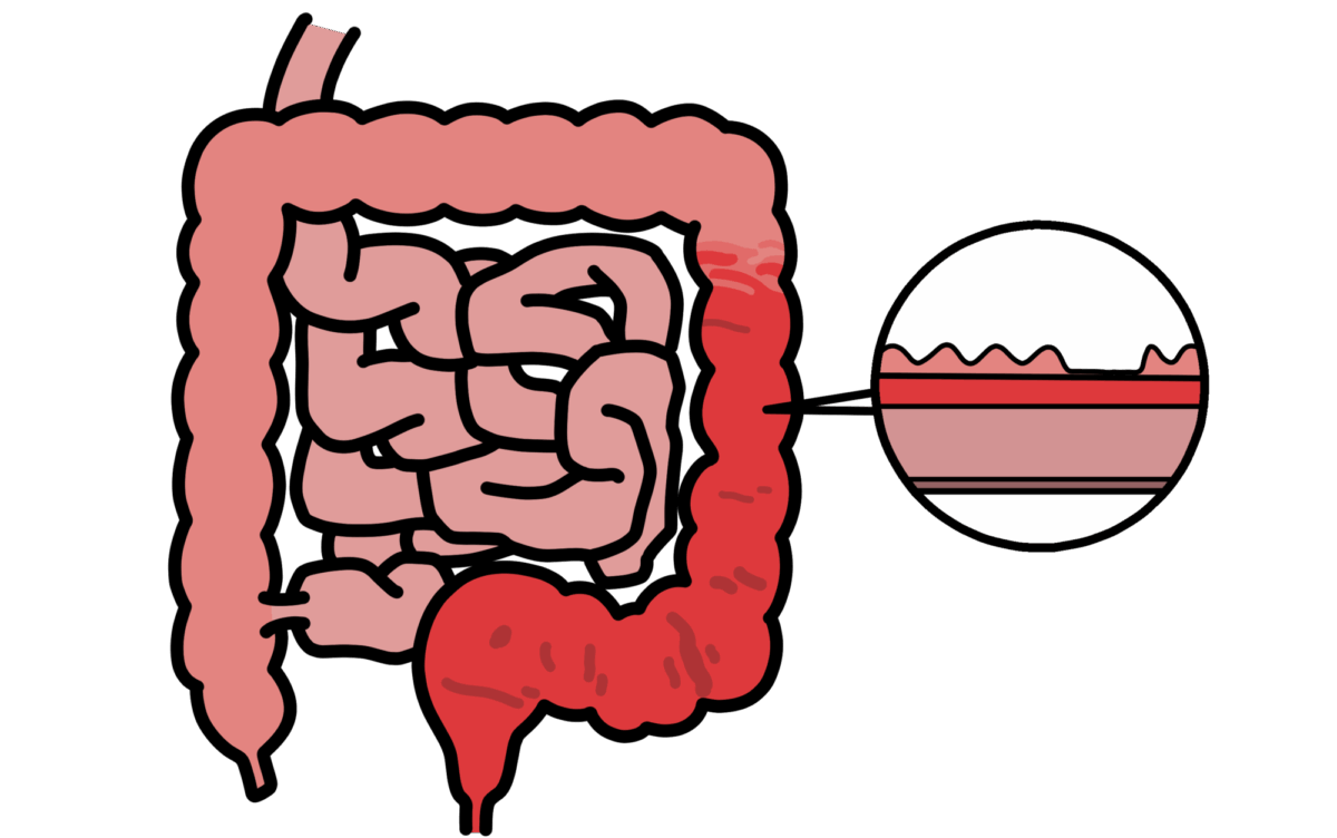 潰瘍性大腸炎
