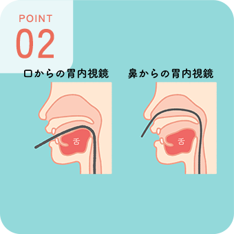 POINT 02 胃カメラ検査の挿入方法は口・鼻から選択可