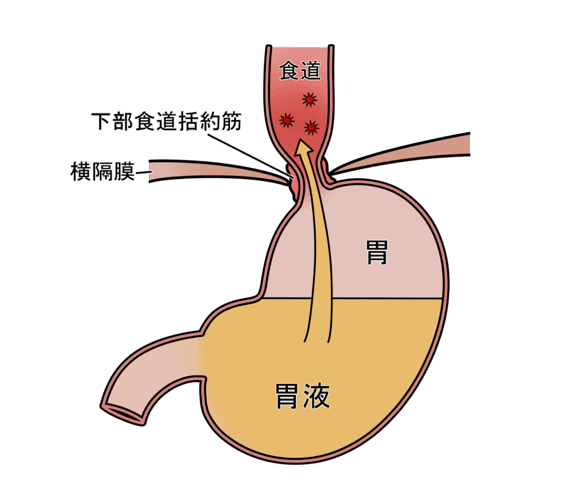 逆流性食道炎
